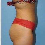 Abdominoplasty Before & After Patient #8116