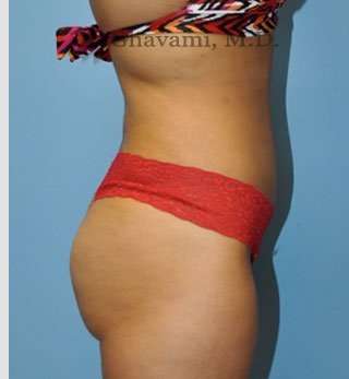 Abdominoplasty Before & After Patient #8116