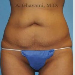 Abdominoplasty Before & After Patient #8116