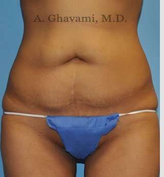 Abdominoplasty Before & After Patient #8116