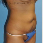 Abdominoplasty Before & After Patient #8116