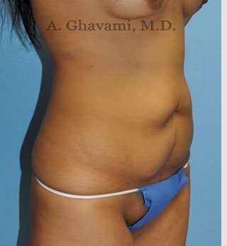 Abdominoplasty Before & After Patient #8116
