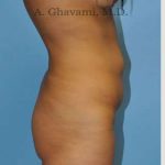 Abdominoplasty Before & After Patient #8116