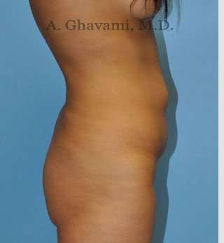 Abdominoplasty Before & After Patient #8116