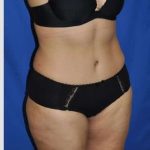 Abdominoplasty Before & After Patient #8109