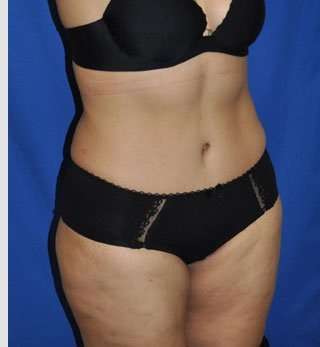 Abdominoplasty Before & After Patient #8109