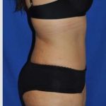 Abdominoplasty Before & After Patient #8109