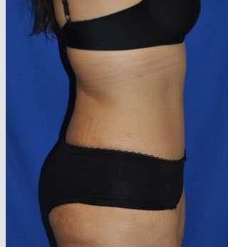 Abdominoplasty Before & After Patient #8109