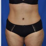 Abdominoplasty Before & After Patient #8109