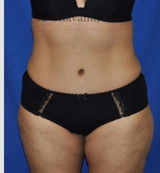 Abdominoplasty Before & After Patient #8109