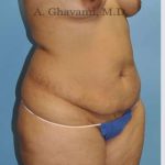 Abdominoplasty Before & After Patient #8109