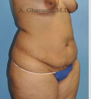 Abdominoplasty Before & After Patient #8109