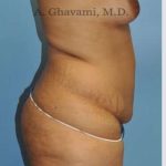 Abdominoplasty Before & After Patient #8109