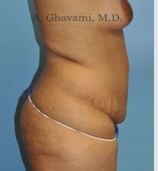 Abdominoplasty Before & After Patient #8109