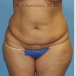 Abdominoplasty Before & After Patient #8109