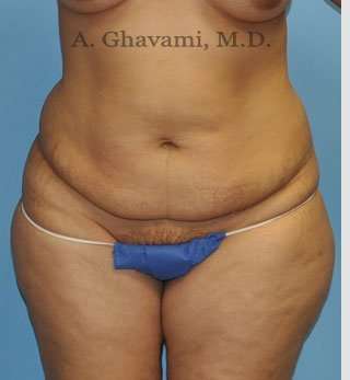 Abdominoplasty Before & After Patient #8109