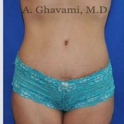 Abdominoplasty Before & After Patient #8102