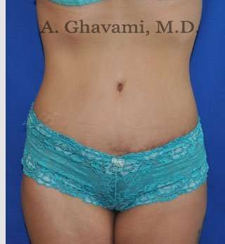 Abdominoplasty Before & After Patient #8102