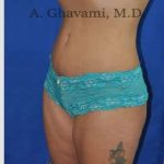 Abdominoplasty Before & After Patient #8102