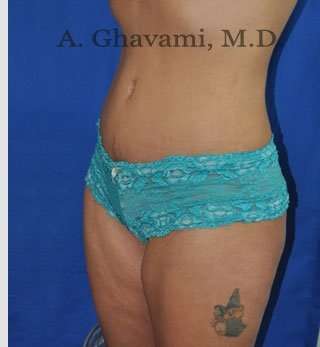 Abdominoplasty Before & After Patient #8102
