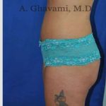 Abdominoplasty Before & After Patient #8102