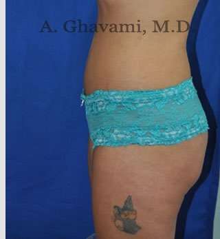 Abdominoplasty Before & After Patient #8102