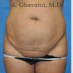 Abdominoplasty Before & After Patient #8102