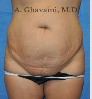 Abdominoplasty Before & After Patient #8102