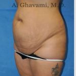 Abdominoplasty Before & After Patient #8102