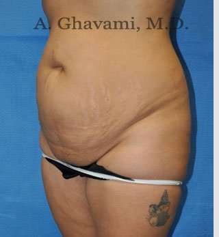 Abdominoplasty Before & After Patient #8102