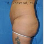 Abdominoplasty Before & After Patient #8102