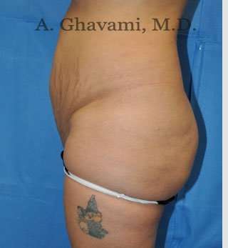 Abdominoplasty Before & After Patient #8102