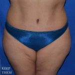Abdominoplasty Before & After Patient #8095