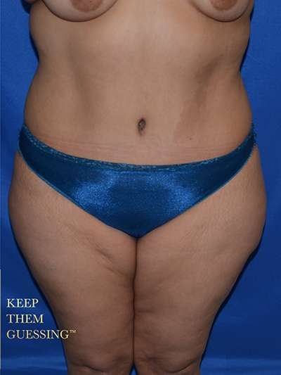Abdominoplasty Before & After Patient #8095