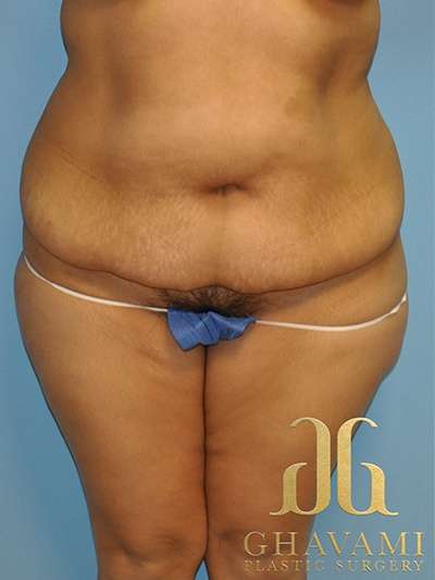 Abdominoplasty Before & After Patient #8095