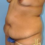 Abdominoplasty Before & After Patient #8095