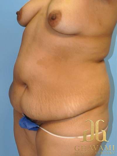 Abdominoplasty Before & After Patient #8095