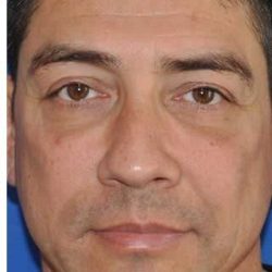Blepharoplasty Before & After Patient #8083