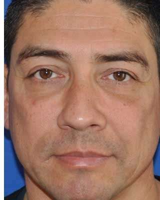 Blepharoplasty Before & After Patient #8083