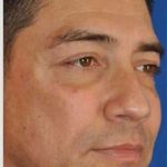 Blepharoplasty Before & After Patient #8083