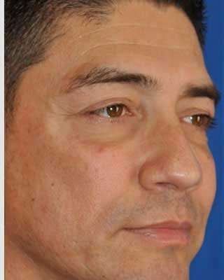 Blepharoplasty Before & After Patient #8083