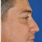 Blepharoplasty Before & After Patient #8083