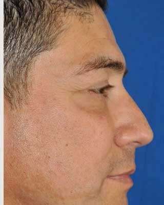 Blepharoplasty Before & After Patient #8083
