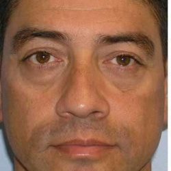 Blepharoplasty Before & After Patient #8083