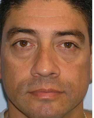 Blepharoplasty Before & After Patient #8083