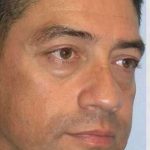 Blepharoplasty Before & After Patient #8083