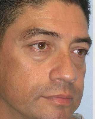 Blepharoplasty Before & After Patient #8083