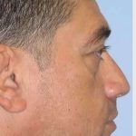 Blepharoplasty Before & After Patient #8083