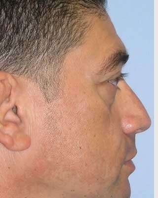 Blepharoplasty Before & After Patient #8083