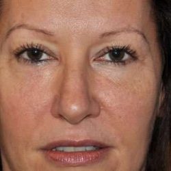 Blepharoplasty Before & After Patient #8067